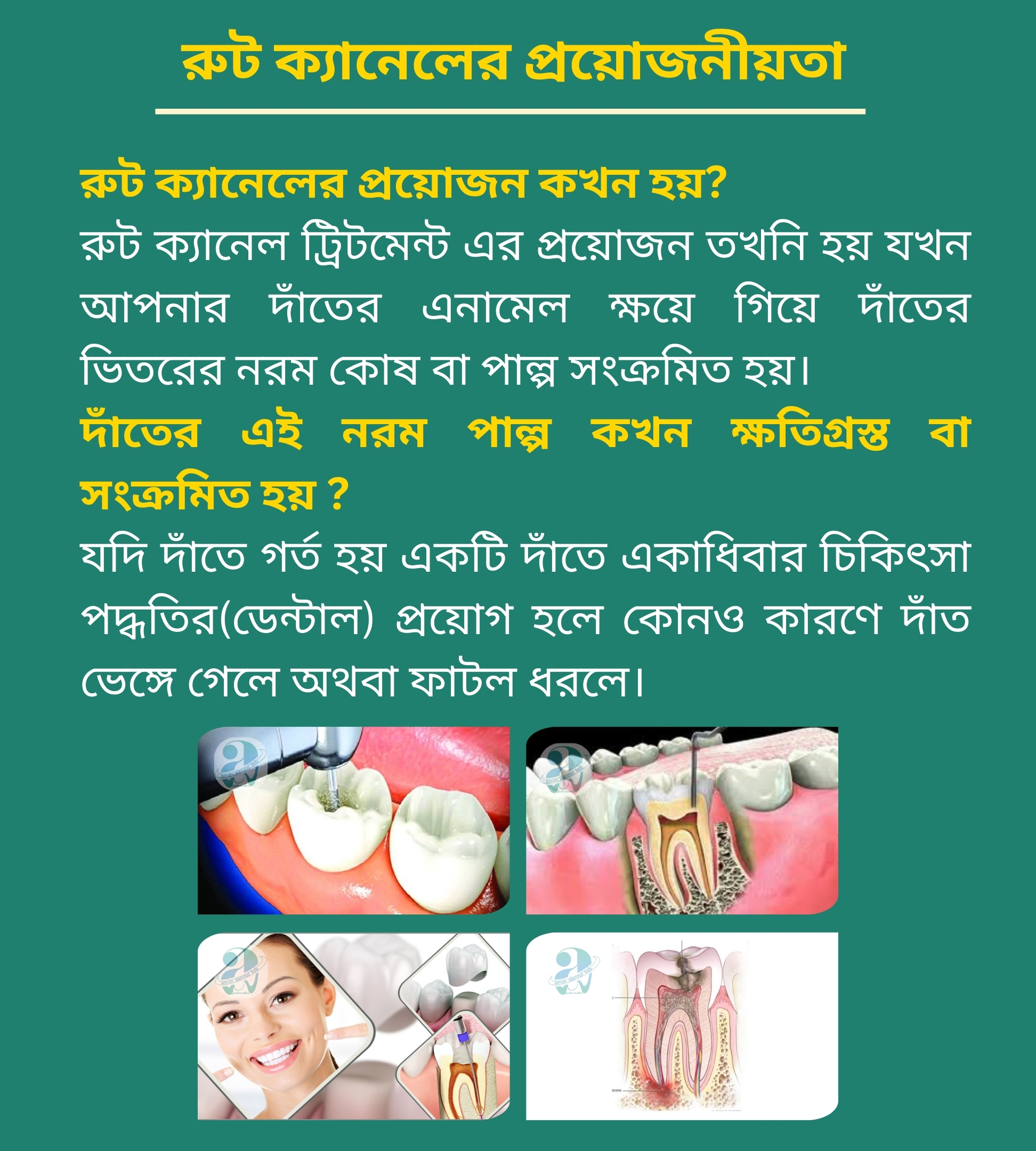 রূট ক্যানেলের প্রয়োজনীয়তা