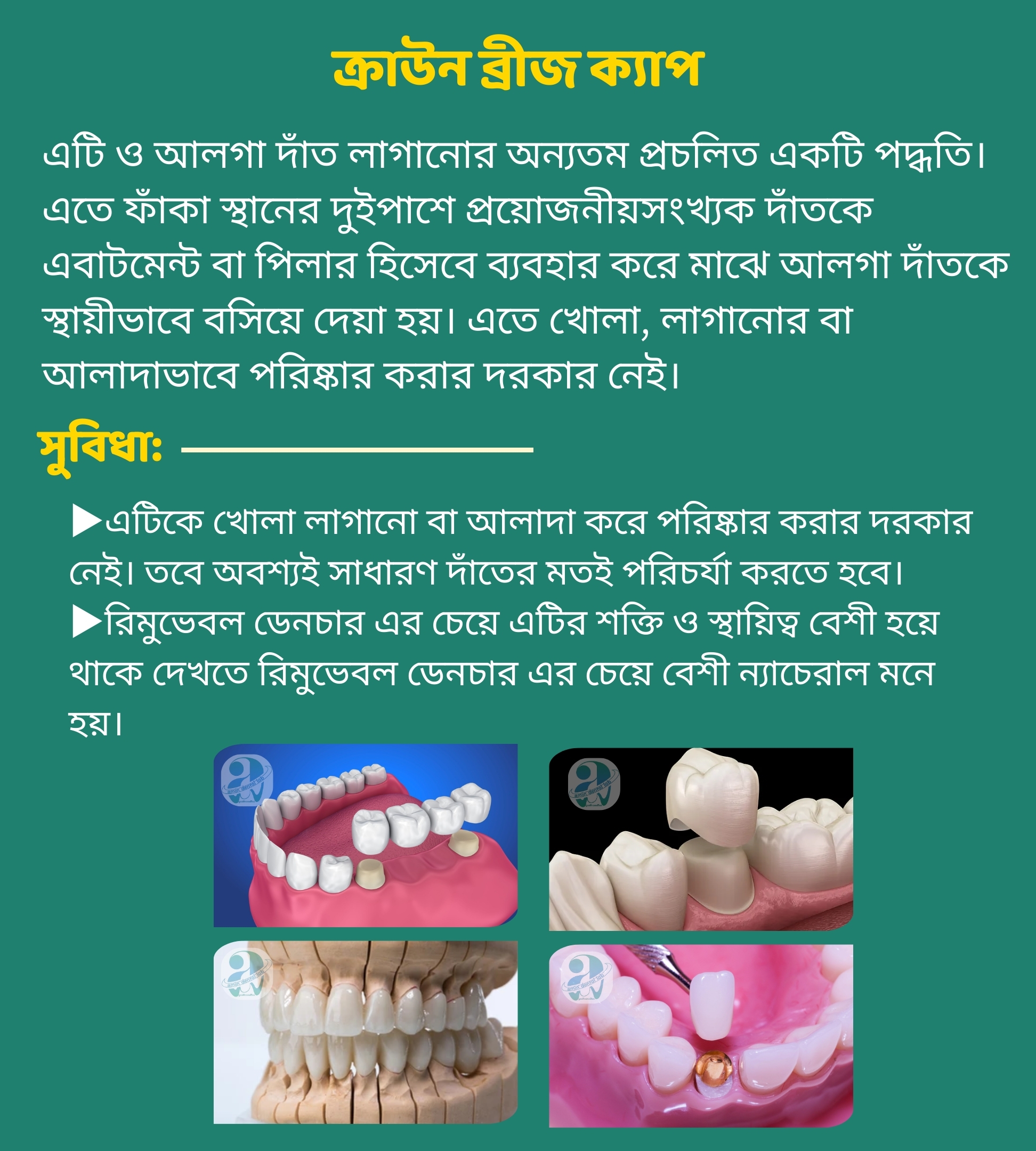 ক্রাউন ব্রীজ ক্যাপ