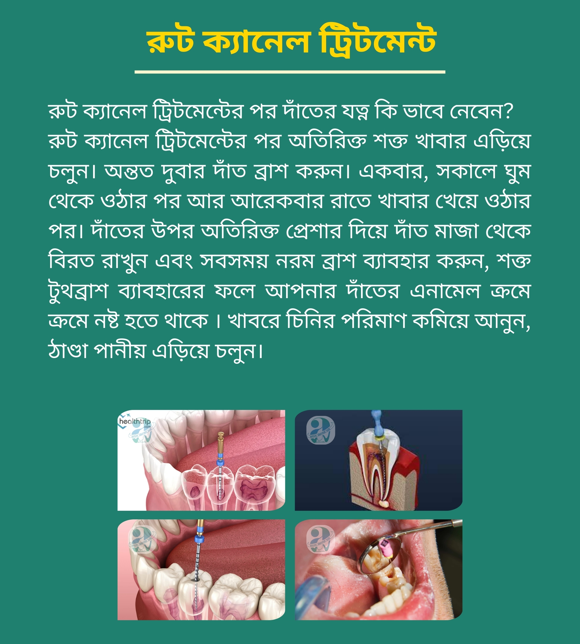 রূট ক্যানেল ট্রিটমেন্ট